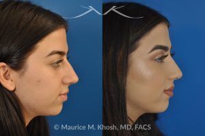 Photo of a patient before and after a procedure. Rhinoplasty and Septoplasty for Hump Removal and Tip Refinement - 21 year old female wanted a nasal hump removed and the tip of her nose refined. She has breathing obstruction due to a crooked septum. She underwent a closed rhinoplasty and septoplasty. during rhinoplasty, the nasal hump was removed, nasal bones were narrowed, and a columellar strut placed to improve her nasal tip position.
