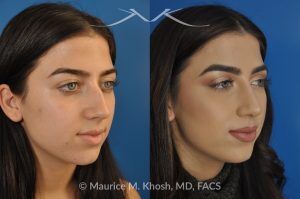 Photo of a patient before and after a procedure. Rhinoplasty and Septoplasty for Hump Removal and Tip Refinement - 21 year old female wanted a nasal hump removed and the tip of her nose refined. She has breathing obstruction due to a crooked septum. She underwent a closed rhinoplasty and septoplasty. during rhinoplasty, the nasal hump was removed, nasal bones were narrowed, and a columellar strut placed to improve her nasal tip position.