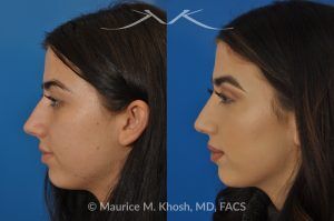 Photo of a patient before and after a procedure. Rhinoplasty and Septoplasty for Hump Removal and Tip Refinement - 21 year old female wanted a nasal hump removed and the tip of her nose refined. She has breathing obstruction due to a crooked septum. She underwent a closed rhinoplasty and septoplasty. during rhinoplasty, the nasal hump was removed, nasal bones were narrowed, and a columellar strut placed to improve her nasal tip position.