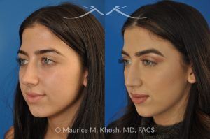 Photo of a patient before and after a procedure. Rhinoplasty and Septoplasty for Hump Removal and Tip Refinement - 21 year old female wanted a nasal hump removed and the tip of her nose refined. She has breathing obstruction due to a crooked septum. She underwent a closed rhinoplasty and septoplasty. during rhinoplasty, the nasal hump was removed, nasal bones were narrowed, and a columellar strut placed to improve her nasal tip position.