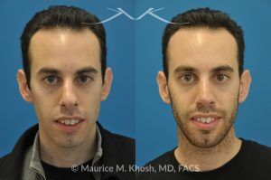 Photo of a patient before and after a procedure. Rhinoplasty for Hump Reduction, Tip Refinement and Nostril Narrowing - This gentleman was interested in rhinoplasty to address a large hump, wide tip, excess nostril show, and wide nostrils. Surgery was performed via the open rhinoplasty approach.