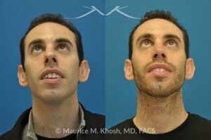 Photo of a patient before and after a procedure. Rhinoplasty for Hump Reduction, Tip Refinement and Nostril Narrowing - This gentleman was interested in rhinoplasty to address a large hump, wide tip, excess nostril show, and wide nostrils. Surgery was performed via the open rhinoplasty approach.