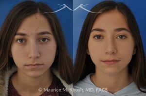 Photo of a patient before and after a procedure. Rhinoplasty for a Refined Nose With Smooth Bridge, Tip Elevation, and Tip Narrowing - before-and-after composite photo.