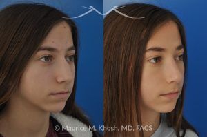 Photo of a patient before and after a procedure. Rhinoplasty for a Refined Nose With Smooth Bridge, Tip Elevation, and Tip Narrowing - before-and-after composite photo.