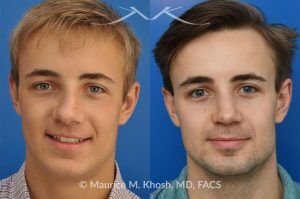 Photo of a patient before and after a procedure. Rhinoplasty for Crooked Nose and Nasal Obstruction, 10 Years Post Op - 10 year post op results after rhinoplasty to straighten a crooked nose and alleviate severe nasal obstruction. An open approach rhinoplasty was used to achieve these results. 