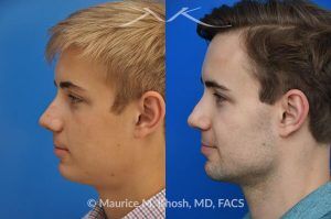 Photo of a patient before and after a procedure. Rhinoplasty for Crooked Nose and Nasal Obstruction, 10 Years Post Op - 10 year post op results after rhinoplasty to straighten a crooked nose and alleviate severe nasal obstruction. An open approach rhinoplasty was used to achieve these results. 
