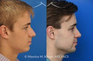 Photo of a patient before and after a procedure. Rhinoplasty for Crooked Nose and Nasal Obstruction, 10 Years Post Op - 10 year post op results after rhinoplasty to straighten a crooked nose and alleviate severe nasal obstruction. An open approach rhinoplasty was used to achieve these results. 