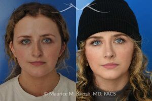 Photo of a patient before and after a procedure. Rhinoplasty to Correct Nasal Hump and Drooping Tip - This amazing 22 year-old was bothered by the droopiness of the tip of her nose and the large nasal hump. We used the open approach to perform septoplasty, dorsal reduction, caudal septum shortening, cephalic trimming, and alar strut grafts. She is delighted with the improved breathing, and loves the new shape of her tip and the bridge of her nose. 