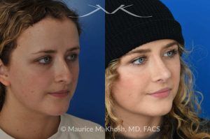 Photo of a patient before and after a procedure. Rhinoplasty to Correct Nasal Hump and Drooping Tip - This amazing 22 year-old was bothered by the droopiness of the tip of her nose and the large nasal hump. We used the open approach to perform septoplasty, dorsal reduction, caudal septum shortening, cephalic trimming, and alar strut grafts. She is delighted with the improved breathing, and loves the new shape of her tip and the bridge of her nose. 