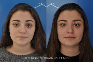 Photo of a patient before and after a procedure. Rhinoplasty to Straighten a Crooked Nose and Refine the Nasal Profile - before-and-after composite photo.