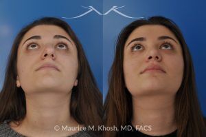 Photo of a patient before and after a procedure. Rhinoplasty to Straighten a Crooked Nose and Refine the Nasal Profile - before-and-after composite photo.