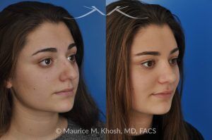 Photo of a patient before and after a procedure. Rhinoplasty to Straighten a Crooked Nose and Refine the Nasal Profile - before-and-after composite photo.