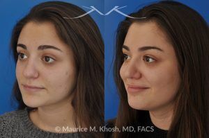 Photo of a patient before and after a procedure. Rhinoplasty to Straighten a Crooked Nose and Refine the Nasal Profile - before-and-after composite photo.