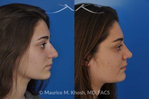 Photo of a patient before and after a procedure. Rhinoplasty to Straighten a Crooked Nose and Refine the Nasal Profile - before-and-after composite photo.