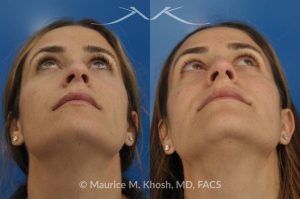 Photo of a patient before and after a procedure. Rhinoplasty for Bridge Straightening and Functional Correction - This procedure corrected the nasal bridge asymmetry and improved the patient’s breathing function.