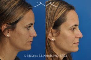 Photo of a patient before and after a procedure. Rhinoplasty for Bridge Straightening and Functional Correction - This procedure corrected the nasal bridge asymmetry and improved the patient’s breathing function.