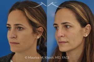 Photo of a patient before and after a procedure. Rhinoplasty for Bridge Straightening and Functional Correction - This procedure corrected the nasal bridge asymmetry and improved the patient’s breathing function.