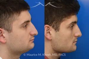 Photo of a patient before and after a procedure. Rhinoplasty for Nasal Obstruction and Aesthetic Correction - This patient's main complaint was bilateral severe nasal obstruction. His secondary concern was the dorsal hump and droopy nasal tip. We used an open rhinoplasty approach to straighten his deviated septum, lower the dorsal hump and place bilateral spreader grafts to widen the internal nasal valve to enhance his breathing. The nasal tip was reduced in size and rotated to achieve the desired tip position. 