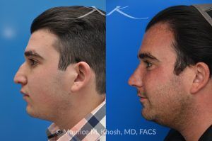 Photo of a patient before and after a procedure. 9 Years Post-Rhinoplasty After Nasal Fracture - These photos show the long-term result—9 years after rhinoplasty to smooth the nasal bridge and refine tip position. The patient had a previous nasal fracture that affected both the appearance and alignment of the nose.