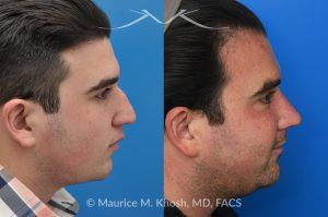 Photo of a patient before and after a procedure. 9 Years Post-Rhinoplasty After Nasal Fracture - These photos show the long-term result—9 years after rhinoplasty to smooth the nasal bridge and refine tip position. The patient had a previous nasal fracture that affected both the appearance and alignment of the nose.