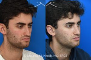 Photo of a patient before and after a procedure. Open Septorhinoplasty for Functional and Aesthetic Correction - This young gentleman presented with significant left-sided nasal obstruction. His goals included improved nasal breathing, a straighter dorsal profile, and elevation of the nasal tip. An open septorhinoplasty was performed, including dorsal reduction, placement of bilateral auto-spreader grafts, an additional spreader graft on the left side, and septo-columellar suture techniques. These measures were utilized to address both functional and aesthetic concerns, resulting in improved airway patency and nasal contour.