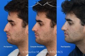 Photo of a patient before and after a procedure. Open Septorhinoplasty for Functional and Aesthetic Correction - This young gentleman presented with significant left-sided nasal obstruction. His goals included improved nasal breathing, a straighter dorsal profile, and elevation of the nasal tip. An open septorhinoplasty was performed, including dorsal reduction, placement of bilateral auto-spreader grafts, an additional spreader graft on the left side, and septo-columellar suture techniques. These measures were utilized to address both functional and aesthetic concerns, resulting in improved airway patency and nasal contour.