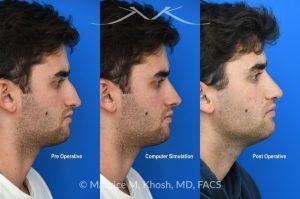 Photo of a patient before and after a procedure. Open Septorhinoplasty for Functional and Aesthetic Correction - This young gentleman presented with significant left-sided nasal obstruction. His goals included improved nasal breathing, a straighter dorsal profile, and elevation of the nasal tip. An open septorhinoplasty was performed, including dorsal reduction, placement of bilateral auto-spreader grafts, an additional spreader graft on the left side, and septo-columellar suture techniques. These measures were utilized to address both functional and aesthetic concerns, resulting in improved airway patency and nasal contour.