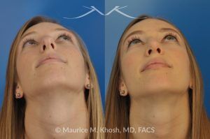 Photo of a patient before and after a procedure. Rhinoplasty to Reduce a Nose Hump, Elevate the Nose Tip, and Refine the Nose Tip - before-and-after composite photo.