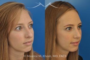 Photo of a patient before and after a procedure. Rhinoplasty to Reduce a Nose Hump, Elevate the Nose Tip, and Refine the Nose Tip - before-and-after composite photo.