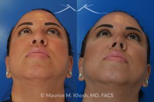 Photo of a patient before and after a procedure. Rhinoplasty to Refine and Elevate the Tip and Eliminate Nasal Hump - This lovely patient sought rhinoplasty in our Manhattan office to address a moderate size hump and to improve the nasal tip. She disliked the droopy nasal tip with poor definition. Rhinoplasty performed through the open approach allowed refinement and rotation of the nasal tip, and smoothing of the nasal hump.