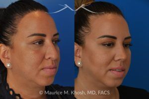 Photo of a patient before and after a procedure. Rhinoplasty to Refine and Elevate the Tip and Eliminate Nasal Hump - This lovely patient sought rhinoplasty in our Manhattan office to address a moderate size hump and to improve the nasal tip. She disliked the droopy nasal tip with poor definition. Rhinoplasty performed through the open approach allowed refinement and rotation of the nasal tip, and smoothing of the nasal hump.
