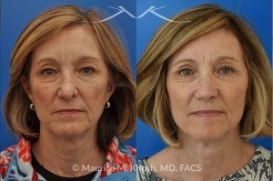 Photo of a patient before and after a procedure. Secondary Repair of Nostril Retraction After Mohs Surgery - This lovely 60 year-old had undergone repair of Mohs cancer removal from the left lower nose, by another surgeon. Unfortunately, this resulted in severe retraction of the left nostril and an unacceptable nasal deformity. 
Rhinoplasty to address nostril retraction was performed in Manhattan. Cartilage graft to the left nostril and composite graft (combination of skin and cartilage graft) to the inside edge of the nostril, helped to restore normality to the nose. The post op pictures are 6 months following her rhinoplasty.