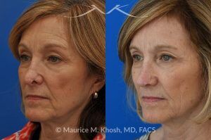 Photo of a patient before and after a procedure. Secondary Repair of Nostril Retraction After Mohs Surgery - This lovely 60 year-old had undergone repair of Mohs cancer removal from the left lower nose, by another surgeon. Unfortunately, this resulted in severe retraction of the left nostril and an unacceptable nasal deformity. 
Rhinoplasty to address nostril retraction was performed in Manhattan. Cartilage graft to the left nostril and composite graft (combination of skin and cartilage graft) to the inside edge of the nostril, helped to restore normality to the nose. The post op pictures are 6 months following her rhinoplasty.