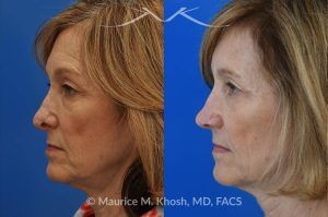 Photo of a patient before and after a procedure. Secondary Repair of Nostril Retraction After Mohs Surgery - This lovely 60 year-old had undergone repair of Mohs cancer removal from the left lower nose, by another surgeon. Unfortunately, this resulted in severe retraction of the left nostril and an unacceptable nasal deformity. 
Rhinoplasty to address nostril retraction was performed in Manhattan. Cartilage graft to the left nostril and composite graft (combination of skin and cartilage graft) to the inside edge of the nostril, helped to restore normality to the nose. The post op pictures are 6 months following her rhinoplasty.