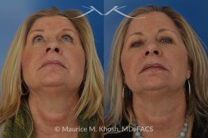 Photo of a patient before and after a procedure. Subtle Rhinoplasty to Correct Nasal Tip Deviation, Reduce Hump, and Refine the Nose - This subtle rhinoplasty procedure addresses the deviation of the nasal tip, reduces a nasal hump, and narrows and elevates the tip for a more balanced and refined appearance.

