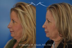 Photo of a patient before and after a procedure. Subtle Rhinoplasty to Correct Nasal Tip Deviation, Reduce Hump, and Refine the Nose - This subtle rhinoplasty procedure addresses the deviation of the nasal tip, reduces a nasal hump, and narrows and elevates the tip for a more balanced and refined appearance.

