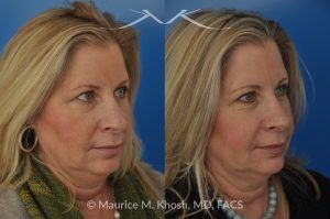 Photo of a patient before and after a procedure. Subtle Rhinoplasty to Correct Nasal Tip Deviation, Reduce Hump, and Refine the Nose - This subtle rhinoplasty procedure addresses the deviation of the nasal tip, reduces a nasal hump, and narrows and elevates the tip for a more balanced and refined appearance.

