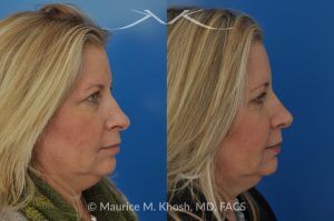 Photo of a patient before and after a procedure. Subtle Rhinoplasty to Correct Nasal Tip Deviation, Reduce Hump, and Refine the Nose - This subtle rhinoplasty procedure addresses the deviation of the nasal tip, reduces a nasal hump, and narrows and elevates the tip for a more balanced and refined appearance.

