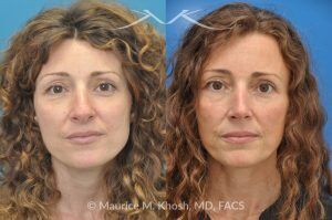 Photo of a patient before and after a procedure. Tip and Bridge Refinement - This young lady requested rhinoplasty to address dorsal hump, wide tip, and hanging columella. Surgery performed through the open rhinoplasty approach.