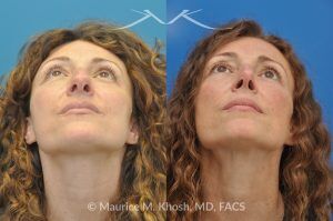 Photo of a patient before and after a procedure. Tip and Bridge Refinement - This young lady requested rhinoplasty to address dorsal hump, wide tip, and hanging columella. Surgery performed through the open rhinoplasty approach.