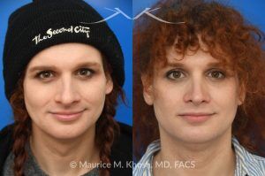 Photo of a patient before and after a procedure. Rhinoplasty to Reduce Nasal Hump and Refine the Tip - This rhinoplasty procedure focused on reducing a prominent nasal hump and refining the nasal tip to create a more balanced and harmonious profile. The result is a natural, proportionate enhancement of the nose.

