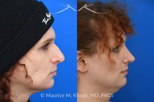 Photo of a patient before and after a procedure. Rhinoplasty to Reduce Nasal Hump and Refine the Tip - This rhinoplasty procedure focused on reducing a prominent nasal hump and refining the nasal tip to create a more balanced and harmonious profile. The result is a natural, proportionate enhancement of the nose.

