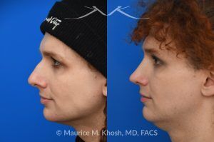 Photo of a patient before and after a procedure. Rhinoplasty to Reduce Nasal Hump and Refine the Tip - This rhinoplasty procedure focused on reducing a prominent nasal hump and refining the nasal tip to create a more balanced and harmonious profile. The result is a natural, proportionate enhancement of the nose.

