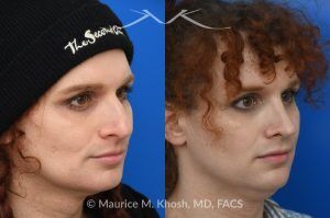 Photo of a patient before and after a procedure. Rhinoplasty to Reduce Nasal Hump and Refine the Tip - This rhinoplasty procedure focused on reducing a prominent nasal hump and refining the nasal tip to create a more balanced and harmonious profile. The result is a natural, proportionate enhancement of the nose.

