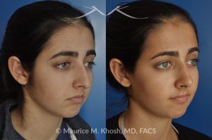 Photo of a patient before and after a procedure. Rhinoplasty for Tip Elevation, Lowering of Nasal Hump, and Narrowing the Nasal Tip - before-and-after composite photo.