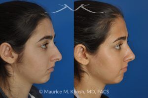 Photo of a patient before and after a procedure. Rhinoplasty for Tip Elevation, Lowering of Nasal Hump, and Narrowing the Nasal Tip - before-and-after composite photo.