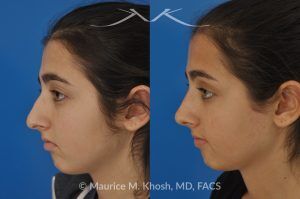 Photo of a patient before and after a procedure. Rhinoplasty for Tip Elevation, Lowering of Nasal Hump, and Narrowing the Nasal Tip - before-and-after composite photo.