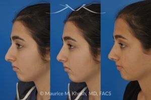 Photo of a patient before and after a procedure. Rhinoplasty for Tip Elevation, Lowering of Nasal Hump, and Narrowing the Nasal Tip - before-and-after composite photo.