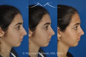 Photo of a patient before and after a procedure. Rhinoplasty for Tip Elevation, Lowering of Nasal Hump, and Narrowing the Nasal Tip - before-and-after composite photo.