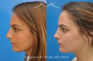 Photo of a patient before and after a procedure. Natural Result After Rhinoplasty for Nose Hump Correction - before-and-after composite photo.